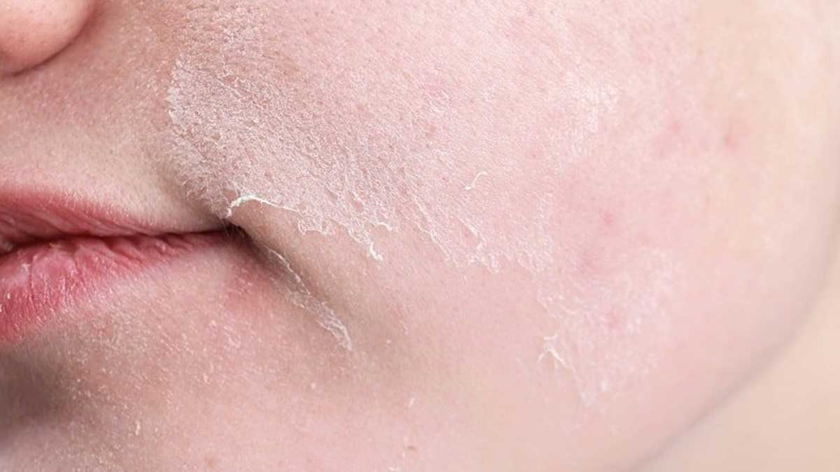 نشانه‌های آسیب نور آبی بر پوست خشک