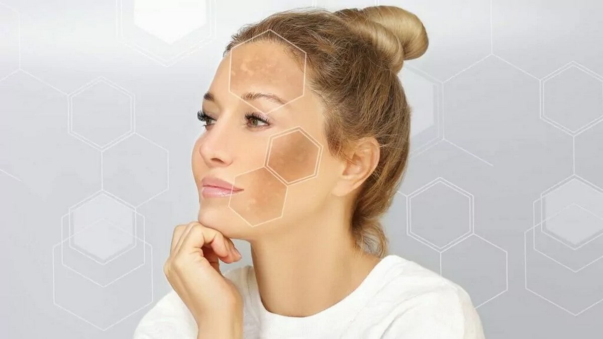رفع تیرگی پوست صورت و بدن