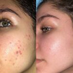 ژل ضد جوش و لایه بردار دیفرین