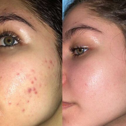 ژل ضد جوش و لایه بردار دیفرین