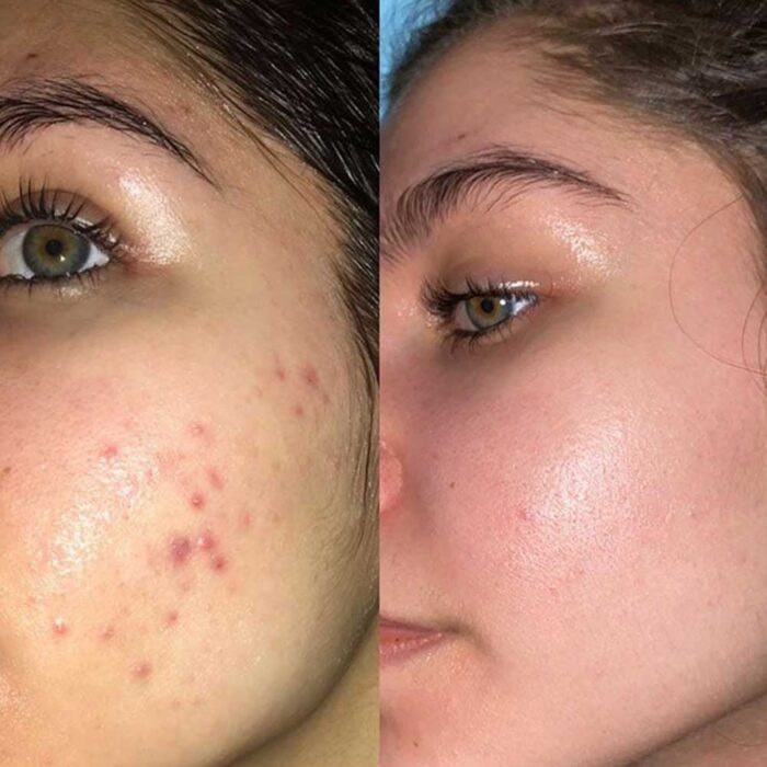 ژل ضد جوش و لایه بردار دیفرین